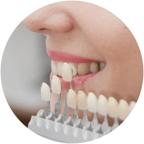 Carillas dentales de porcelana en Talavera de la Reina Clínica dental Sevilleja